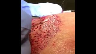 فیلم کاشت مو