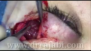 تومور بزرگ عروقی در پشت چشم