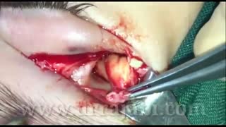 جراحی تومور داخل استخوانی کاسه چشم