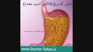ترش کردن یا رفلاکس اسید معده