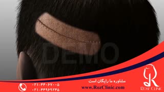 کاشت مو | فیلم کاشت مو | کلینیک پوست و مو رز | شماره 24