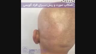 اسکالپ صورت و ریش برای افراد آلوپسی