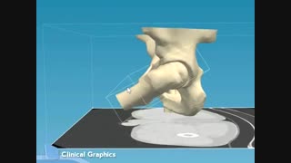 شایع ترین علل آرتروز لگن