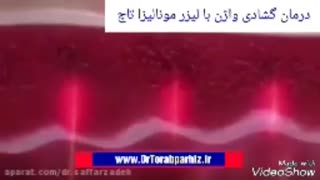 درمان گشادی واژن با لیزر مونالیز تاچ