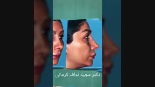 تزریق چربی به صورت جوانسازی پوست