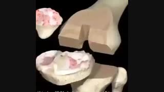 انیمیشنی جالب از تعویض مفصل زانو