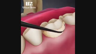 جرمگیری دندان | دکتر لیلا عطایی کاشت ریش