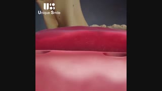 ایمپلنت بر پایه بریج | دکتر لیلا عطایی لیفت صورت
