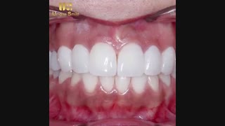 لمینیت سرامیکی | دکتر لیلا عطایی رفع چین و چروک