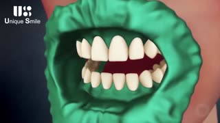 بلیچینگ دندان | دکتر لیلا عطایی زاویه سازی صورت