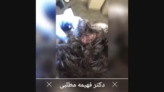 تجربه مزوتراپی درمان ریزش مو