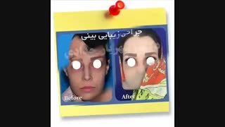 نتیجه جراحی بینی !!!