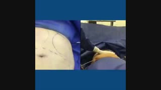 جراحی زیبایی شکم !!!