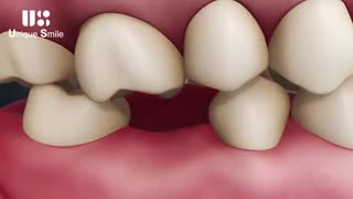 عوارض از دست دادن دندان | دکتر لیلا عطایی
