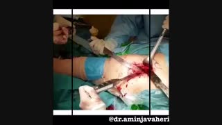 تعویض کامل مفصل لگن سمت چپ به دنبال در رفتگی مادرزادی لگن