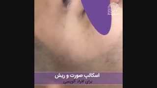 میکرواسکالپ سر و ریش