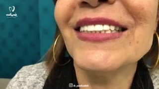 فیلم نحوه اصلاح رنگ و ارتفاع دندان ها به روش روکش لمینت زیرکونیوم