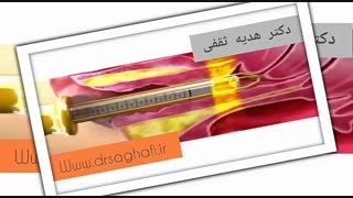 فیلم لیزر واژن