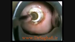 نحوه فریز کردن زخم دهانه رحم