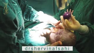 نحوه عمل سزارین