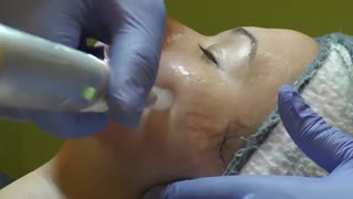 میکرونیدلینگ برای زیبایی