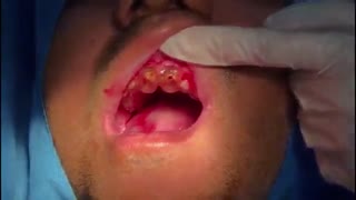 جراحی ایمپلنت به روش نوین