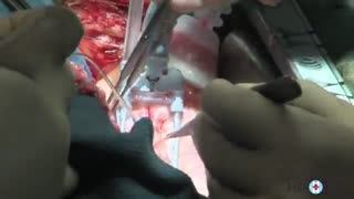 عمل قلب باز