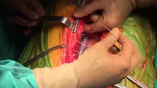 عمل قلب باز