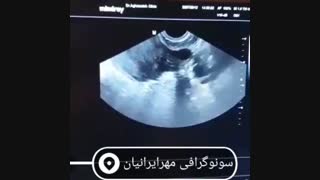 سونوگرافی بارداری داخل رحم یا خارج از رحم
