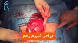 جراحی فیبروم رحم