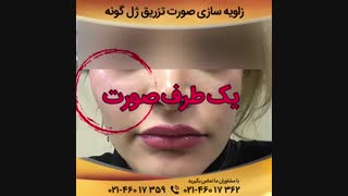تزریق ژل گونه