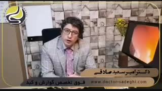درمان هلیکوباکتر پیلوری