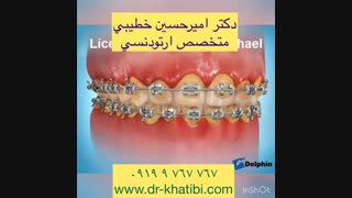 عوارض عدم رعایت بهداشت در ارتودنسی