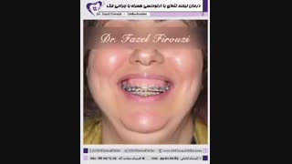 درمان لبخند لثه ای | دکتر فیروزی