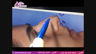 عمل بینی توسط دکتر کیوان کاوان لیفت ابرو