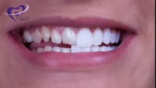 رنگ دندان ها | دکتر فاضل فیروزی
