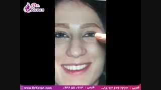 یکی از سختترین عملهای زیبایی بینی دکتر کیوان کاوان کلینیک دندانپزشکی