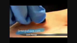 زالودرمانی در بیمارستانهای آمریکا