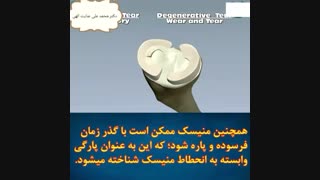 پارگی منیسک زانو