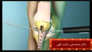 بازسازی رباط صلیبی