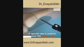 اصلاح انحراف زانو