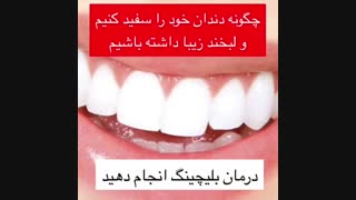 اهمیت بلیچینگ دندان