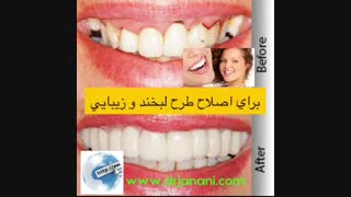 روکش دندان