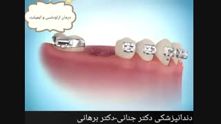 درمان همزمان ایمپلنت و ارتودنسی دندان