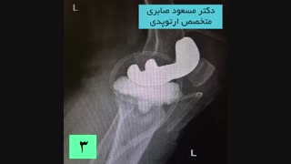 درمان عفونت بعد از تعویض مفصل زانو