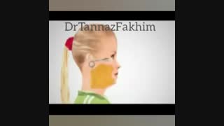 لیفت گردن با نخ