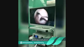 پارگی رباط صلیبی در آرتروسکوپی زانو | دکتر مسعود صابری لیزر فرکشنال