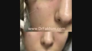 تزریق فیلر زیر چشم