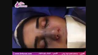 عمل جراحی زیبایی بینی|دکتر کیوان کاوان تزریق بوتاکس