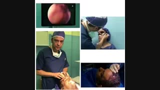 لیفت آندوسکوپیک ابرو و پیشانی توسط دکتر مسعود ناصری صدر درمان ریزش مو